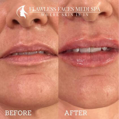 Thin Lips  Flawless Med Spa