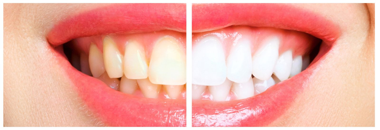 A before and after picture of teeth whitening